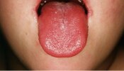 Tongue Colour Meaning : ಡಾಕ್ಟರ್ ನಾಲಿಗೆ ನೋಡಿ ರೋಗವನ್ನು ಹೇಗೆ ಪತ್ತೆ ಹಚ್ಚುತ್ತಾರೆ? ಇಲ್ಲಿದೆ ನೋಡಿ