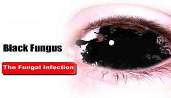 Black Fungus: ಖಾಸಗಿ ಅಂಗಗಳ ಮೇಲೂ Mucormycosis ದಾಳಿ ಇಡುತ್ತಂತೆ ಎಚ್ಚರ!