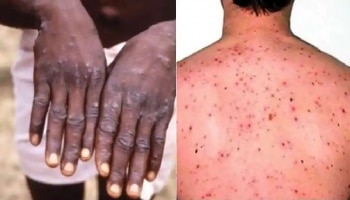 Monkeypox: ಕೊರೊನಾ ಪ್ರಕೋಪದ ನಡುವೆ ತಲೆ ಎತ್ತುತ್ತಿದೆ ಈ ಹೊಸ ಕಾಯಿಲೆ, 100ರಲ್ಲಿ 10 ಜನರ ಸಾವಿನ ಅಪಾಯ