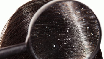 Dandruff Remedies: ತಲೆಹೊಟ್ಟಿನ ಸಮಸ್ಯೆ ನಿವಾರಿಸಲು ಇಲ್ಲಿದೆ ಸಿಂಪಲ್ ಟಿಪ್ಸ್