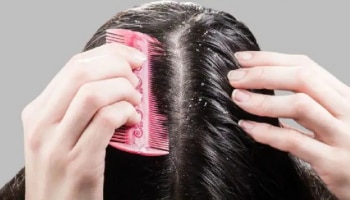 Dandruff Treatment : ತಲೆಹೊಟ್ಟಿಗೆ ಶಾಶ್ವತ ಪರಿಹಾರ ಮತ್ತು ಸುಂದರ ಕೂದಲಿಗೆ ತಪ್ಪದೆ ಬಳಸಿ ಈ ಮನೆಮದ್ದುಗಳನ್ನ 