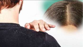 Dandruff Problem : ತಲೆಹೊಟ್ಟಿನ ಸಮಸ್ಯೆಗೆ 10 ಮನೆ ಮದ್ದುಗಳು 