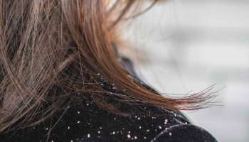 Dandruff Problem: ತಲೆಹೊಟ್ಟಿಗೆ ಶಾಶ್ವತವಾಗಿ ವಿದಾಯ ಹೇಳಲು ನೈಸರ್ಗಿಕ ಮಾರ್ಗಗಳಿವು 