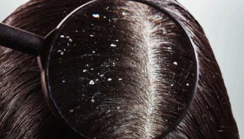Dandruff Solution: ತಲೆಹಿಟ್ಟಿನ ಸಮಸ್ಯೆಯೇ..? ಇಲ್ಲಿದೆ ಶಾಶ್ವತ ಪರಿಹಾರ