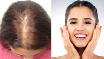 Hair Fall Problem: ಇದನ್ನು ತಿನ್ನುವುದರಿಂದ ನಿಮ್ಮ ಕೂದಲು ಉದುರುವುದಿಲ್ಲ, ಟ್ರೈ ಮಾಡಿ 