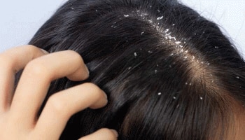 Hair Care Tips: ಶಾಂಪೂವಿನಲ್ಲಿ ಈ ವಸ್ತುಗಳನ್ನು ಬೆರೆಸಿ ಬಳಸಿದರೆ ಶೀಘ್ರವೇ ಕೊನೆಗೊಳ್ಳುತ್ತೆ ಡ್ಯಾಂಡ್ರಫ್