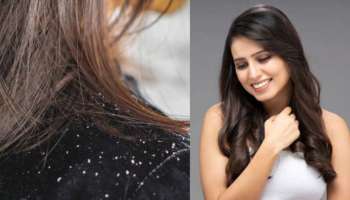 Dandruff Treatment: ಡ್ಯಾಂಡ್ರಫ್ ಸಮಸ್ಯೆಗೆ ಕೇವಲ 10 ರೂ.ಗಳಲ್ಲಿ ಪಡೆಯಿರಿ ಪರಿಹಾರ 