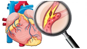 Cholesterol Control: ಇದನ್ನು ಅತಿ ಜಾಸ್ತಿ ಸೇವಿಸಿದರೆ ಜೀವಕ್ಕೆ ಅಪಾಯ, ಕಾರಣ ಇಲ್ಲಿದೆ