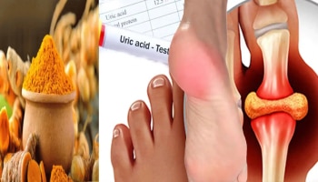 Turmeric Health Tips: ಯೂರಿಕ್ ಆಸಿಡ್ ಸಮಸ್ಯೆಗೆ ಇಲ್ಲಿದೆ ಬೆಸ್ಟ್ ಮನೆಮದ್ದು