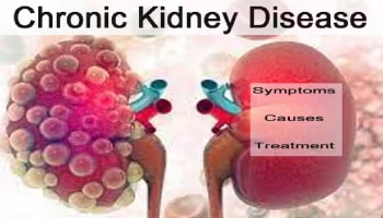 Chronic Kidney Disease : ಕಿಡ್ನಿ ವೈಫಲ್ಯದ ಲಕ್ಷಣಗಳು, ಕಾರಣಗಳು ಮತ್ತು ಚಿಕಿತ್ಸೆಗಳ ಮಾಹಿತಿ ಇಲ್ಲಿದೆ!