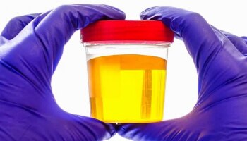 Urine Colour: ಮೂತ್ರದ ಬಣ್ಣದಿಂದಲೇ ನಿಮ್ಮ ಆರೋಗ್ಯದ ಸ್ಥಿತಿ ತಿಳಿಯಿರಿ!