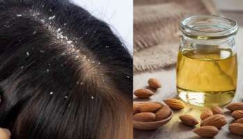 Dandruff Problem​: ಡ್ಯಾಂಡ್ರಫ್ ಸಮಸ್ಯೆಗೆ ಶಾಶ್ವತ ಪರಿಹಾರ ನೀಡುತ್ತೆ ಈ ಮನೆಮದ್ದು 