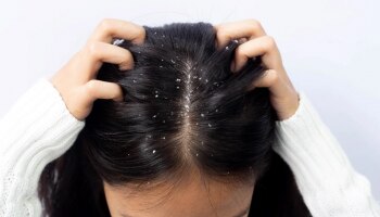 Anti Dandruff : ನೀವು ಡ್ಯಾಂಡ್ರಫ್ ಸಮಸ್ಯೆಯಿಂದ ಬಳಲುತ್ತಿದ್ದೀರಾ? ಹಾಗಿದ್ರೆ. ಇಲ್ಲಿದೆ ಮನೆ ಮದ್ದುಗಳು!