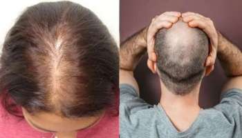 Long Hair Remedies: ಬೋಳು ತಲೆ ಸಮಸ್ಯೆಗೆ ರಾಮಬಾಣ ಈ ಐದು ವಸ್ತುಗಳು 