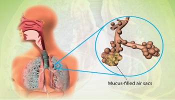 Pneumonia: ನ್ಯುಮೋನಿಯಾದ ಪ್ರಾರಂಭಿಕ ಸೂಚನೆಗಳನ್ನು ಗುರುತಿಸುವುದು ಹೇಗೆ..?