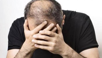 ಪುರುಷರೇ ಬೊಕ್ಕ ತಲೆ ಸಮಸ್ಯೆಯಿಂದ ನೀವೂ ತೊಂದರೆಗೀಡಾಗಿದ್ದೀರಾ? ಚಿಂತೆ ಬಿಟ್ಟು ಈ ಸುದ್ದಿ ಓದಿ!