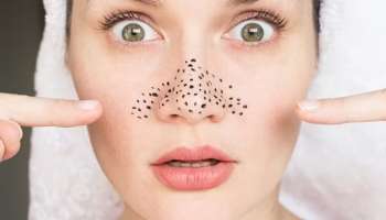 Blackhead Home remedies : ಮನೆಯಲ್ಲಿಯೇ ತಯಾರಿಸುವ ಈ ಸ್ಕ್ರಬ್ ನೀಡುವುದು ಬ್ಲಾಕ್ ಹೆಡ್ ನಿಂದ ಶಾಶ್ವತ ಪರಿಹಾರ