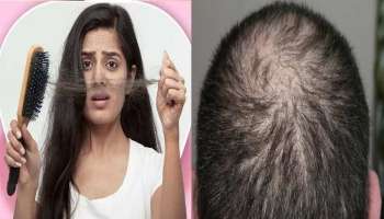 Hair Fall Control Tips: ಕೂದಲುವುರುವ ಸಮಸ್ಯೆಗೆ ವಾರಕ್ಕೊಮ್ಮೆ ಈ ಮನೆಮದ್ದು ಅನುಸರಿಸಿ ನೋಡಿ ಸಾಕು!