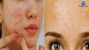 Skin Care: ಮೊಡವೆಯಿಂದ ಶೀಘ್ರದಲ್ಲೇ ಪರಿಹಾರ ಪಡೆಯಲು ಆಯುರ್ವೇದ ಸಲಹೆ 