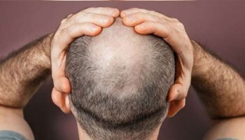 Hair Loss Home Remedies: ಬೋಳು ತಲೆ ಸಮಸ್ಯೆ ನಿವಾರಣೆಗೆ ಈ ಸೂಪರ್ ಡ್ರಿಂಕ್ ಎಂದಾದರೂ ಸೇವಿಸಿದ್ದೀರಾ?