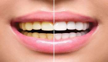 Yellow teeth whitening remedies: ಹಲ್ಲುಗಳಲ್ಲಿ ಆಂಟಿ ಕುಳಿತಿರುವ ಹಳದಿ ಕಲೆಗಳನ್ನು ನಿಮಿಷಗಳಲ್ಲಿ ಮಾಯ ಮಾಡುವ ಸರಳ ಉಪಾಯ ಇದು !