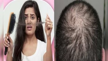 Hair Fall Remedy: ಈ ಎಣ್ಣೆಯಲ್ಲಿದೆ ಕೂದಲು ಉದುರುವ ಸಮಸ್ಯೆ ನಿವಾರಣೆಯ ಅದ್ಭುತ ಸಾಮರ್ಥ್ಯ, ಮನೆಯಲ್ಲಿಯೇ ತಯಾರಿಸಬಹುದು!