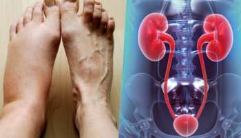 Kidney Health: ಕಿಡ್ನಿ ವೈಫಲ್ಯದ ಮುನ್ಸೂಚನೆ ಪಾದಗಳಲ್ಲಿ ಕಾಣುವ ಈ ಬದಲಾವಣೆ !!