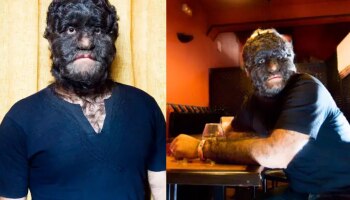 Wolf Man ಹೆಸರಿನಿಂದ ಗಿನ್ನಿಸ್ ಬುಕ್ ನಲ್ಲಿ ಹೆಸರು, ಶೇ 98 ರಷ್ಟು ಮುಖ ಮತ್ತು ಶರೀರದ ಮೇಲೆ ಕೂದಲು!