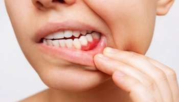 Oral health: ಹಲ್ಲು ಮತ್ತು ವಸಡುಗಳ ಆರೋಗ್ಯಕ್ಕಾಗಿ ಈ ಆಹಾರಗಳನ್ನು ಸೇವಿಸಿ!