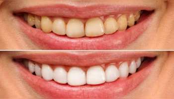 ಈ ಹಣ್ಣನ್ನು ಕಚ್ಚಿ ತಿಂದರೆ ಸಾಕು ಕೊಳಕು ಕೊಳಕು ಹಳದಿ ಹಲ್ಲುಗಳು ಮುತ್ತುಗಳಂತೆ ಹೊಳೆಯುತ್ತವೆ!