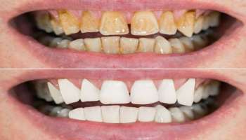 ಪ್ರತಿದಿನ ಹಲ್ಲುಜ್ಜಿದರೂ ಹಲ್ಲುಗಳು ಹಳದಿಯಾಗಿವೆಯೇ.. ಬಾಳೆಹಣ್ಣಿನಿಂದ ಹೀಗೆ ಮಾಡಿ 10 ನಿಮಿಷದಲ್ಲೇ ಮುತ್ತಿನಂತೆ ಬಿಳಿಯಾಗುತ್ತವೆ!