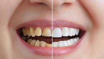 ಈ ಹಣ್ಣಿನ ಸಿಪ್ಪೆಯಲ್ಲಿ ಉಜ್ಜಿದರೆ 2 ನಿಮಿಷದಲ್ಲಿ ಹಲ್ಲಿನ ಮೇಲೆ ಅಂಟಿರುವ ಹಳದಿ ಕಲೆ ಶಾಶ್ವತವಾಗಿ ತೊಲಗುವುದು! 80 ವರ್ಷ ದಾಟಿದ್ರೂ ಹಲ್ಲು ಹುಳುಕಾಗಲ್ಲ