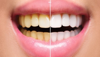 ಹಲ್ಲಿನ ಮೇಲಿನ ಹಳದಿ ಕಲೆಗಳನ್ನು ತೆಗೆದುಹಾಕಲು ಈ ಸರಳ ಪರಿಹಾರ ಪ್ರಯತ್ನಿಸಿ!