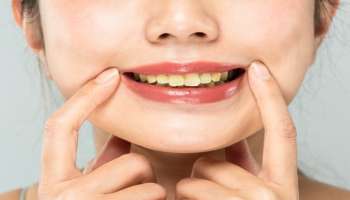 Teeth Color: ಹಲ್ಲುಗಳು ಹಳದಿ ಬಣ್ಣಕ್ಕೆ ತಿರುಗಲು ಈ ವಿಟಮಿನ್‌ ಕೊರತೆಯೇ ಕಾರಣ! ಕೂಡಲೇ ಸಮಸ್ಯೆ ಏನೆಂದು ಹೀಗೆ ಪತ್ತೆಹಚ್ಚಿ