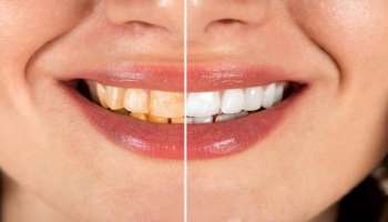 ಶುಂಠಿಗೆ ಈ ಹಣ್ಣಿನ ರಸ ಬೆರೆಸಿ ಉಜ್ಜಿದರೆ ಸಾಕು: ಹಲ್ಲಿನ ಮೇಲೆ ಅಂಟಿಕೊಂಡ ಕೊಳಕು ಹಳದಿ ಕಲೆ ಎರಡೇ ನಿಮಿಷದಲ್ಲಿ ತೊಲಗುತ್ತದೆ!