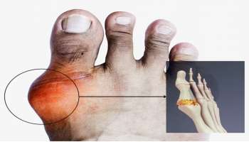 ಯೂರಿಕ್‌ ಆಸಿಡ್‌ ಏಕಾಏಕಿ ಹೆಚ್ಚಳಕ್ಕೆ ಕಾರಣವಾಗುತ್ತೆ ಈ ಹಸಿರು ತರಕಾರಿ! ಕಿಡ್ನಿ ಸ್ಟೋನ್‌ ಉಂಟಾಗುವುದು ಇದರಿಂದಲೇ..  