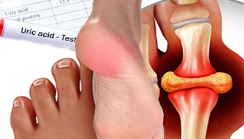 ಈ ಗಿಡಮೂಲಿಕೆಗಳು ಯೂರಿಕ್ ಆಮ್ಲದ ಸಮಸ್ಯೆ ನಿವಾರಿಸುತ್ತವೆ; ಕೀಲು ನೋವಿನಿಂದ ಪರಿಹಾರ ಸಿಗುತ್ತೆ!!