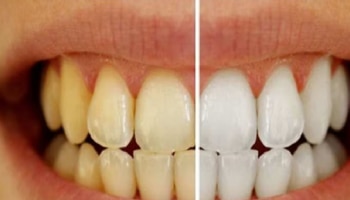 ನಿಮ್ಮ ಹಲ್ಲಿನ ಕೊಳೆ ಸ್ವಚ್ಛಗೊಳಿಸಲು ʼಈʼ ವಸ್ತು ಬಳಸಿ; ಹಳದಿ ಹಲ್ಲುಗಳು ಹಾಲಿನಂತೆ ಬೆಳ್ಳಗೆ ಹೊಳೆಯುತ್ತವೆ!!