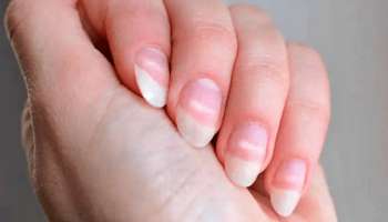 ದೇಹದಲ್ಲಿ ಕ್ಯಾಲ್ಸಿಯಂ ಕೊರತೆಯಿಂದ ಕಾಣಿಸಿಕೊಳ್ಳುವ ಲಕ್ಷಣಗಳು ಯಾವುವು?