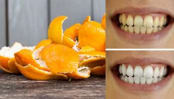 ಈ ಹಣ್ಣಿನ ಸಿಪ್ಪೆಯಿಂದ ಹೀಗೆ ಮಾಡಿ 10 ನಿಮಿಷದಲ್ಲೇ ಮುತ್ತಿನಂತೆ ಬಿಳಿಯಾಗುತ್ತವೆ ಹಳದಿ ಹಲ್ಲು!