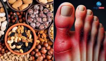 ಯೂರಿಕ್ ಆಸಿಡ್ ಸಮಸ್ಯೆಗೆ ಈ ಒಣಹಣ್ಣುಗಳು ರಾಮಬಾಣ...