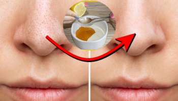 ನಿಂಬೆಹಣ್ಣಿಗೆ ಇದನ್ನು ಬೆರೆಸಿ ಉಜ್ಜಿ ಸಾಕು ಮೂಗಿನ ಮೇಲಿನ ಬ್ಲಾಕ್‌ ಹೆಡ್ಸ್‌ 5 ನಿಮಿಷಗಳಲ್ಲಿ ತೊಲಗುವುದು!