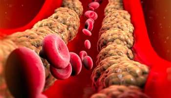 ಕೊಲೆಸ್ಟ್ರಾಲ್ ಹೆಚ್ಚಾದಾಗ ಕಾಲುಗಳಲ್ಲಿ ಈ ಲಕ್ಷಣಗಳು ಕಂಡು ಬರುತ್ತವೆ! ನಿರ್ಲಕ್ಷಿಸಿದರೆ ಎದುರಾಗುವುದು ಹಾರ್ಟ್ ಅಟ್ಯಾಕ್ ಆಪತ್ತು! 