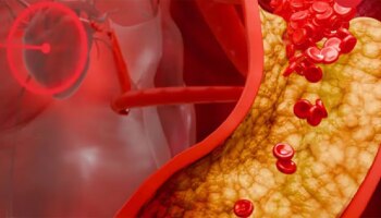 ನಿಮಗೆ ಕೆಟ್ಟ ಕೊಲೆಸ್ಟ್ರಾಲ್ ಬಗ್ಗೆ ಚಿಂತೆ ಇದೆಯೇ? ಇಲ್ಲಿದೆ ಸರಳ ಉಪಾಯ..!