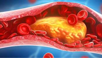 ರಕ್ತನಾಳಗಳಲ್ಲಿ ಸಂಗ್ರಹವಾದ ಕೆಟ್ಟ ಕೊಲೆಸ್ಟ್ರಾಲ್‌ನ್ನು ನಿಮಿಷದಲ್ಲಿ ಹೊರಹಾಕುತ್ತೆ ಬೆಳ್ಳುಳ್ಳಿ! ಆದ್ರೆ ಈ ರೀತಿ ತಿನ್ನಿ ಸಾಕು.. 