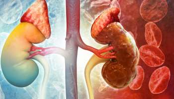 ಮೂತ್ರದಲ್ಲಿನ ಒಂದೇ ಒಂದು ಬದಲಾವಣೆಯೇ ಕಿಡ್ನಿ ಫೇಲ್‌ ಮೊದಲ ಲಕ್ಷಣ! ನಿರ್ಲಕ್ಷಿಸದಿರಿ..