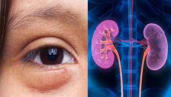 ನಿಮ್ಮ ಕಣ್ಣುಗಳ ಕೆಳಗೆ ಊತ ಬಂದಿದೆಯೇ: ಇವು ಅತ್ಯಂತ ಗಂಭೀರ ಕಾಯಿಲೆಗಳ ಲಕ್ಷಣಗಳು..  