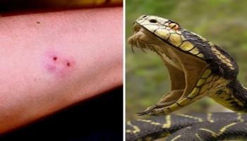 ನಿಮಗೆ ಹಾವು ಕಡಿದರೆ ಈ ಏನನ್ನು ಮಾಡಬೇಕು ಏನನ್ನು ಮಾಡಬಾರದು..! ಇಲ್ಲಿದೆ ಸಂಪೂರ್ಣ ಮಾಹಿತಿ