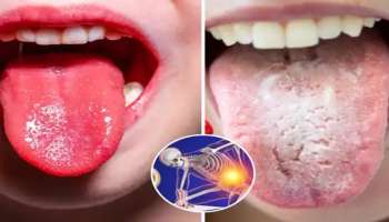 ಬೆಳಗ್ಗೆ ಏಳುತ್ತಿದ್ದಂತೆ ನಾಲಿಗೆ ಮೇಲೆ ಹೀಗೆಲ್ಲಾ ಆಗುತ್ತಿದ್ದರೆ ದೇಹದಲ್ಲಿ ಈ ವಿಟಮಿನ್‌ ಕೊರತೆಯಿದೆ ಎಂದರ್ಥ! ನಿರ್ಲಕ್ಷ್ಯ ಮಾಡಲೇಬೇಡಿ