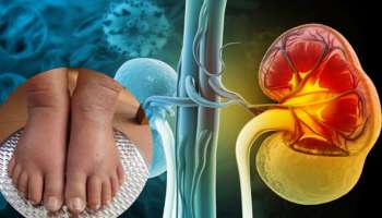 ಕಿಡ್ನಿ ಸಮಸ್ಯೆಯ ಪ್ರಮುಖ ಲಕ್ಷಣ.. ಕಾಲುಗಳಿಗಿಂತ ಮೊದಲೇ ಈ ಭಾಗದಲ್ಲಿ ಕಾಣುವುದು ಊತ, ನೋವು, ತುರಿಕೆ.!